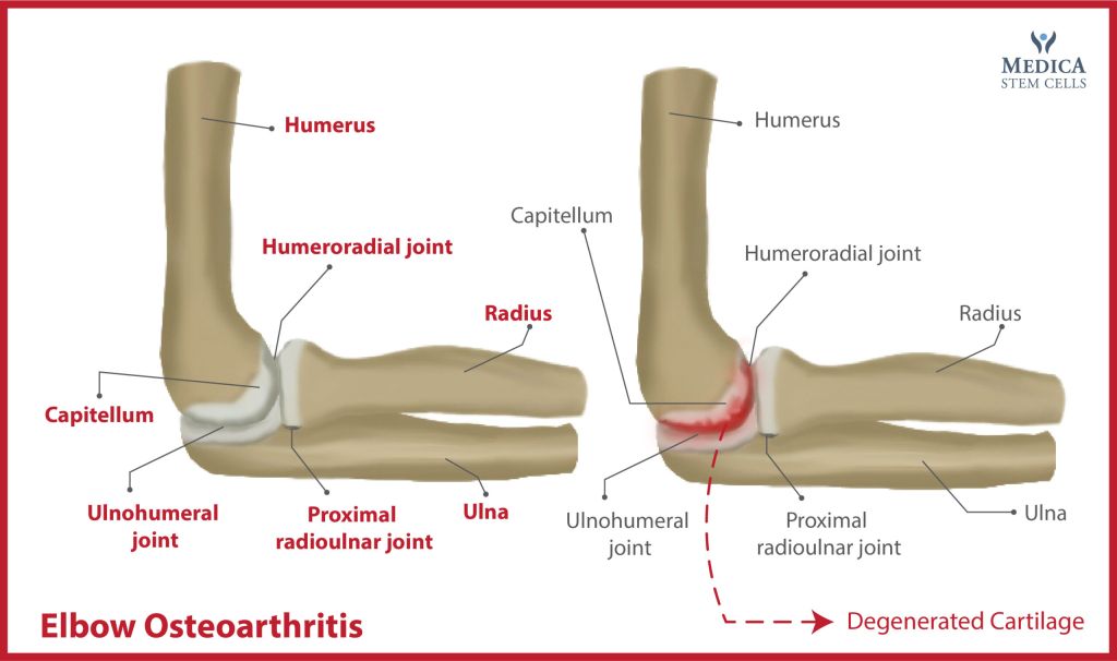 Elbow-Osteoarthritis